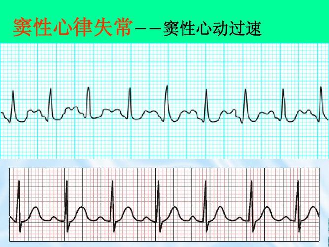 窦性心律不齐是什么意思？严重吗？