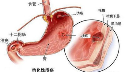 胃溃疡症状表现有哪些